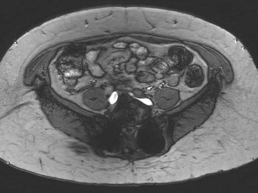 Narrowing of the left common iliac vein to 0.2 cm (MRI).