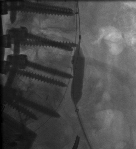 Perforation of a pedicle screw through the anterior cortex of L5 vertebral body visualized during intraluminal inflation of a 12 mm × 40 mm high-pressure balloon.