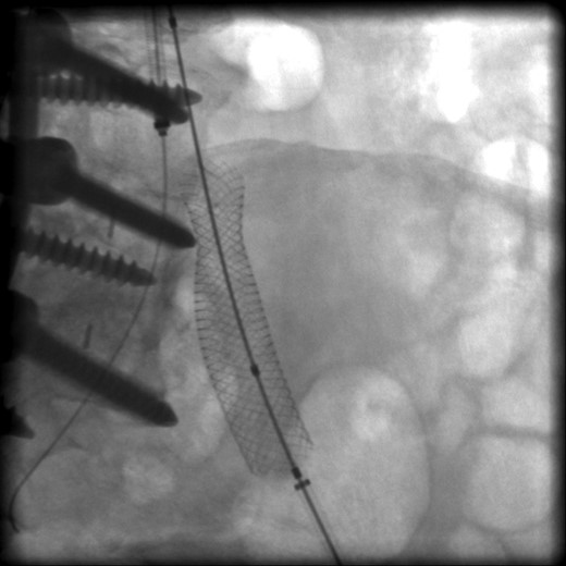 Intraoperative radiograph showing posterior compression of a wall stent within the left common iliac vein.