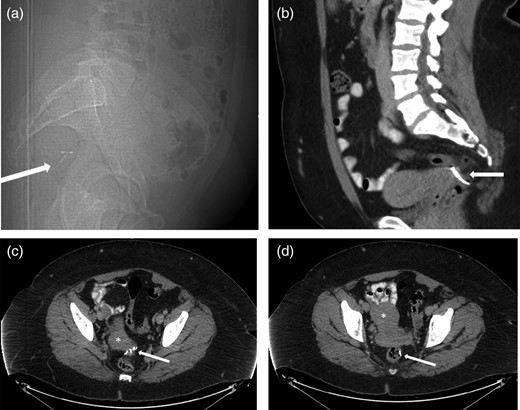 (a) Sagittal CT Scout view shows IUD (arrow) in very posterior location, probably within the rectum. (b) Sagittal contrast-enhanced CT of the pelvis showing the extra-uterine position of the contraceptive device (arrow) posterior to the uterus. (c) Axial contrast-enhanced CT of the pelvis reveals extra-uterine position of the contraceptive device arms (arrow) posterior to the cervix (*). (d) Axial contrast-enhanced CT of the pelvis showing the extra-uterine position of the stem of the contraceptive device within the rectal lumen (arrow) after perforating the uterus (*).