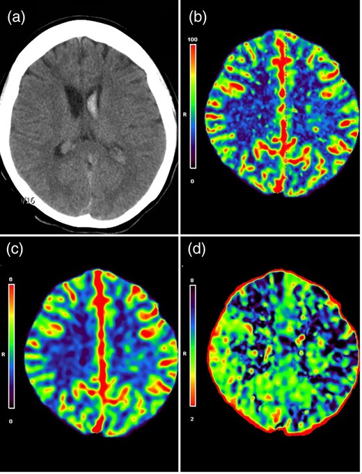(a) CT scan showed primary IVH predominantly on the left lateral ventricle. CT perfusion maps demonstrated symmetric cerebral blood flow (b) and cerebral blood volume (c), but an increased MTT on the left side (d), indicative of a relative hypoperfusion on the left hemisphere.
