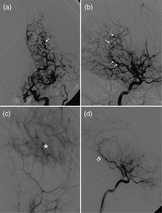 Anteroposterior (a) and lateral (b) views of the right ICA angiogram demonstrated severe stenosis of the ICA termination, formation of moyamoya collateral network and multiple weak spots (dashed arrows: irregular segmental dilatations; single arrow: pseudoaneurysm) along the enlarged intraventricular segment of AChA. (c) Right external carotid angiogram demonstrated a robust collateral formation (asterisk) underlying the site of pial synangiosis. (d) Right ICA angiogram demonstrated that previous weak spots observed along the intraventricular AChA segment (double arrows) significantly regressed or disappeared.