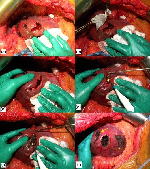 Technique of bleeding control. (a) Intraoperative photograph after enucleating a deep located metastasis. Note that there is a profuse bleeding. (b) Hemostatic tissue is inserted inside the defect. (c) Hemostatic tissue is imbibed with blood and liver borders are brought together with manual compression. (d) The cautery is put at maximum power in coagulate mode and the blood is cooked until a crust is formed. (e) The lateral compression is released and some residual bleeding is controlled with cautery. (f) Final view after the use of the technique (larger arrow). Note that another enucleated area was controlled with the same technique (smaller arrow).