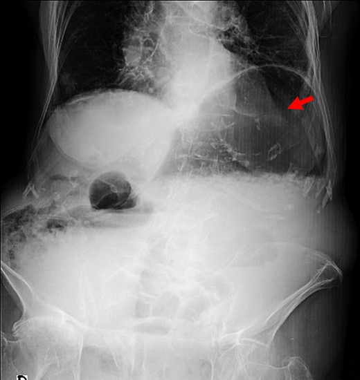 Plain abdominal film with massive gastric distension (red arrow).