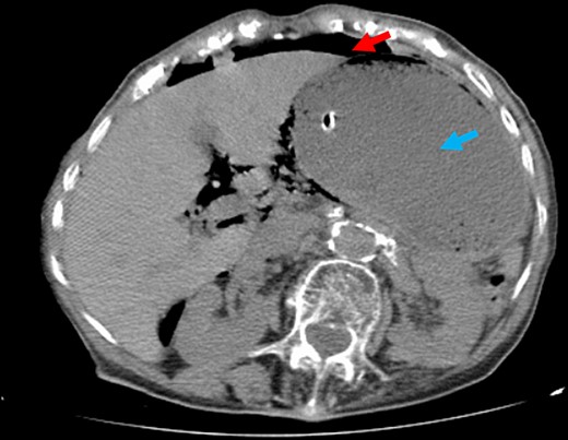 Abdominal CT. Note the large volume pneumoperitoneum (red arrows) and exuberant gastric dilation (blue arrows).