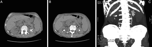 Computed tomography of kidneys, ureters, bladder images demonstrating stone load in a 79-year-old male with CMML, prior to treatment with rasburicase. (A) Partial left-sided stag horn calculi. (B) Bilateral lower pole calculi. (C) Coronal reconstruction demonstrating total renal and ureteric stone load.