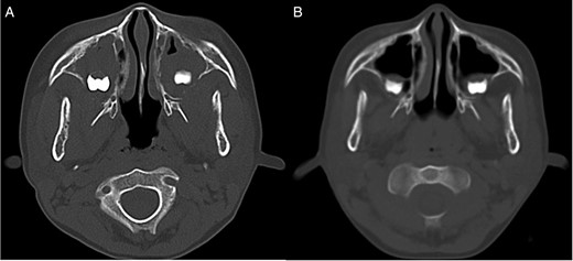 CT image. (A) CT image showing bilateral mass lesions within the maxillary sinuses, with osteolysis involving the posterior walls (right: 3.8 × 3.7 × 2.5 cm, left 3.5 × 3.1 × 2.5 cm). (B) CT image after one course of chemotherapy showing partial reduction of the masses.