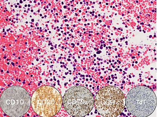 Pathological image. Burkitt's leukaemia stained with haematoxylin & eosin shows infiltration of tumour cells with deeply basophilic cytoplasm, abundant lipid vacuoles in the cytoplasm, multiple small nucleoli and finely dispersed chromatin in the nuclei. Immunostaining was negative for TdT and positive for CD10, CD20, CD79a and Ki67 (circular insets, below).