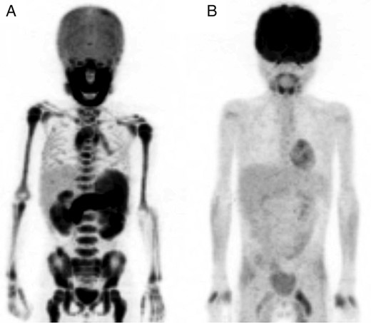 PET/CT image. (A) PET/CT image showing increased 18F-fluorodeoxyglucose uptake in the whole skeleton. (B) PET/CT image after two course of chemotherapy showing complete remission of 18F-fluorodeoxyglucose uptake.