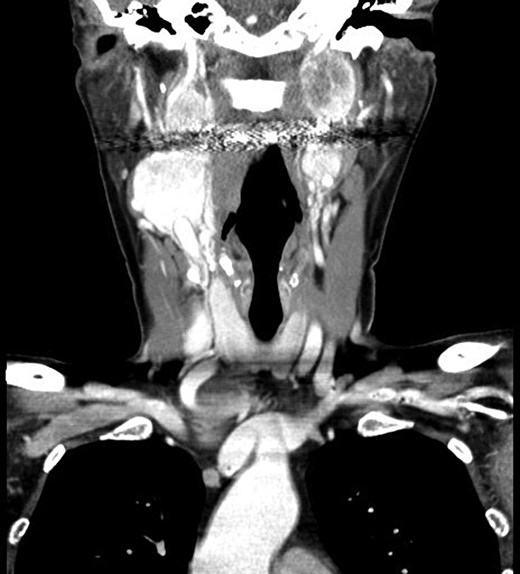 Computed tomography, coronal view, shows multiple bilateral PGLs extending from the carotid bifurcations to the base of the skull, engulfing the vagus nerve.