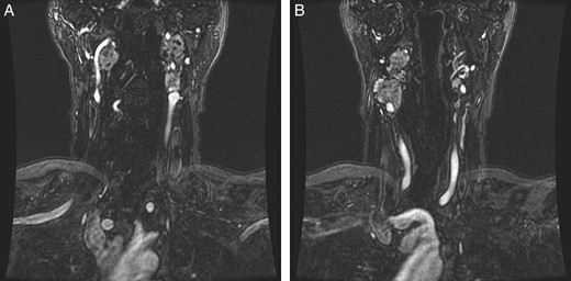(A and B) Magnetic resonance images, coronal planes, highlight three of the four previously noted cervical PGLs decreasing in size, with the right inferior PGL remaining unchanged.
