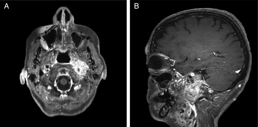 (A and B) Magnetic resonance images, sagittal and coronal planes, show increased left-sided carotid PGL, with significant extension into the jugular foramen and skull base.
