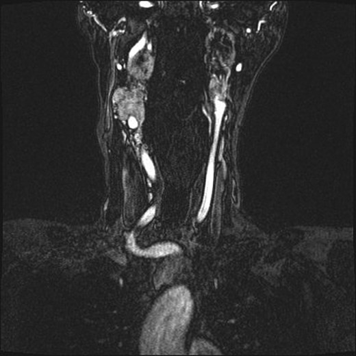 Magnetic resonance angiogram, coronal plane, shows tumor compromise of the left internal carotid artery.