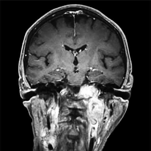CT of the head with contrast, transverse section demonstrating infiltration of left petrous and clivus regions of skull.