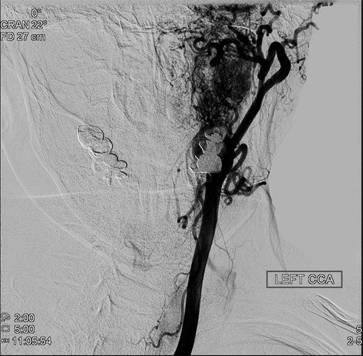 Preoperative angiography shows intricate vascularity of the PGL.