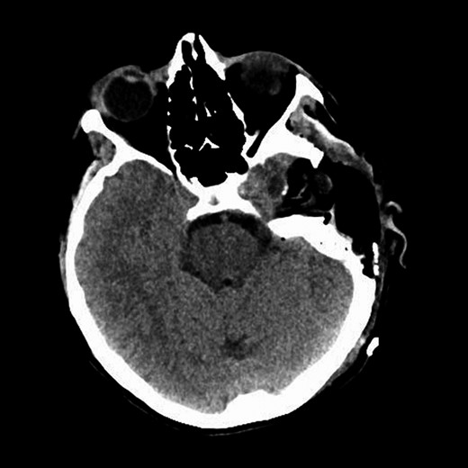 Representative CT image of the head shows postoperative changes associated with left temporal craniotomy and resection.