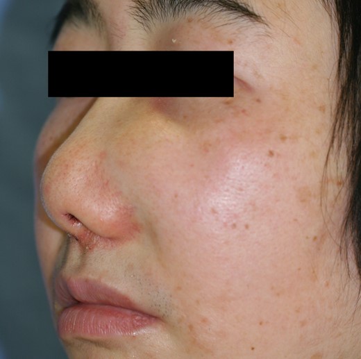 Appearance of the swelling in the left nasal wing at the initial examination.