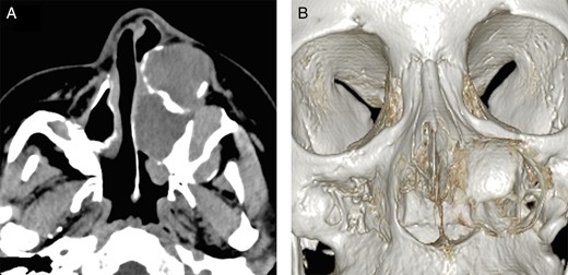 Computed tomographic appearance. (A) Axial computed tomographic section showed a well-defined trilocular cyst in the left maxillary region extending to the cortical plate. (B) Three-dimensional computed tomographic image showing a defect in the nasal lateral wall.