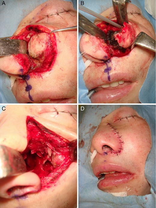 Operative findings in the case. (A) Lateral rhinotomy incision exposing the entire lesion. (B) Serosanguineous fluid filled the cyst cavity. (C) All cyst walls were enucleated. (D) The wound was closed primarily.