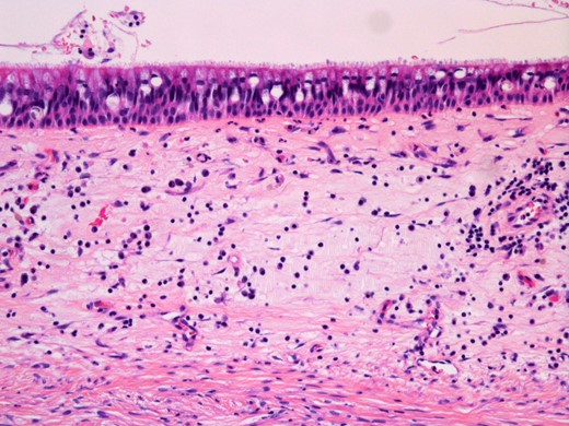 Histopathological findings of the cyst. Haematoxylin and eosin staining showing pseudostratified ciliated epithelium lining the cyst wall (original magnification ×200).