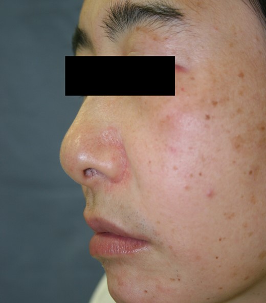 Postoperative appearance showing improvement of the facial deformity.