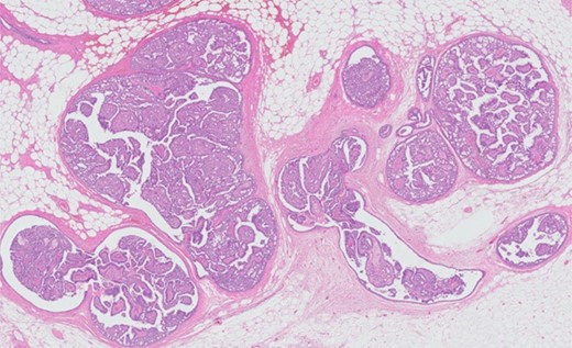 Hematoxylin and eosin stain (HE) overview. HE microphotograph with an overview of the lesion characterized by cystic and papillary architecture. No indication of invasive growth.