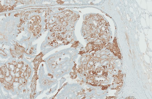 SMA and keratin 5/6 immunohistochemistry demonstrates the presence of myoepithelial cells throughout the lesion with a heterogenous random staining pattern in the keratin 5/6 slide supporting the diagnosis of a benign proliferation.