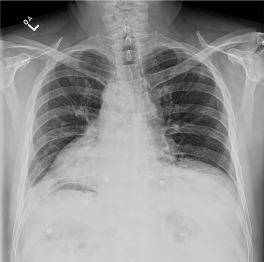 Chest X-ray showing left lower lobe opacity with a small volume of subdiaphragmatic free air.