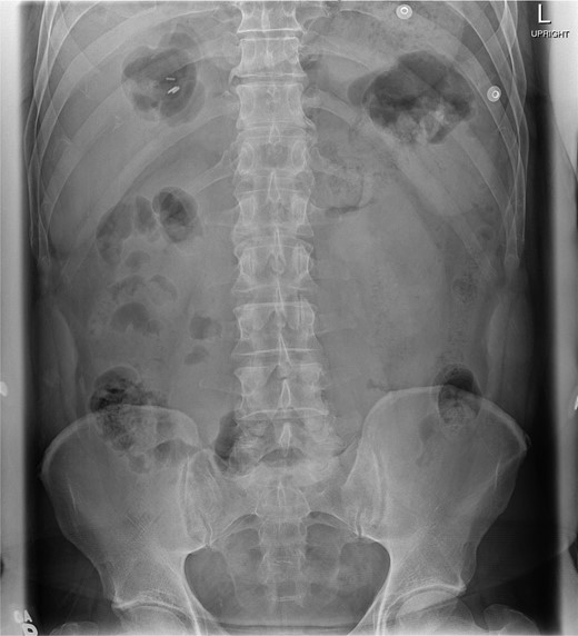Abdominal plain film with no gross abnormalities.