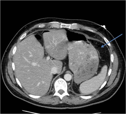 CT scan (axial image) demonstrating gas within the omentum (arrow).