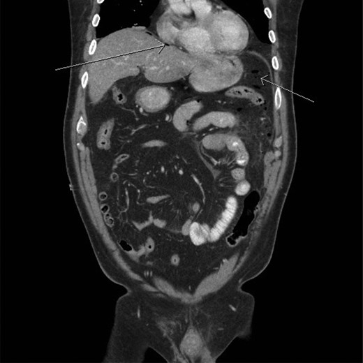 CT scan (frontal view) demonstrating multiple locules of air (arrows).