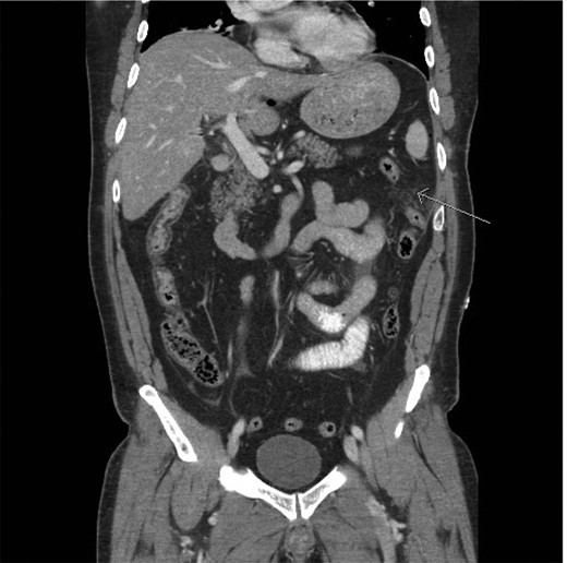 CT scan (frontal view) demonstrating stranding/edema to the omentum (arrow).