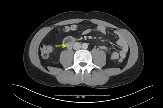 CT scan of linear opaque FB traversing the posterior wall of the duodenum abutting the ureter.