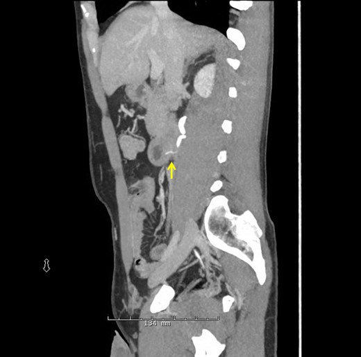 Sagittal CT scan again demonstrating the FB through the posterior wall of the duodenum onto the anterior surface of the ureter.