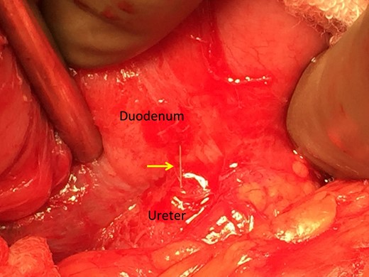 Intraoperative identification of the FB from the duodenum to the ureter.