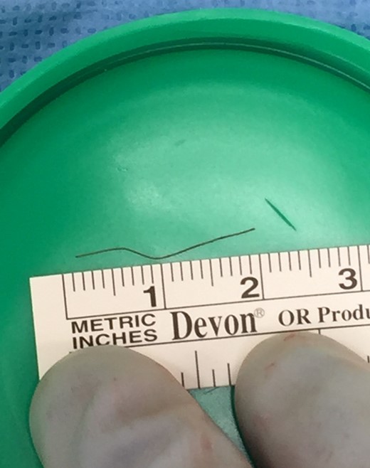 Linear FB (2 cm). Pathology confirmed wire brush bristle.