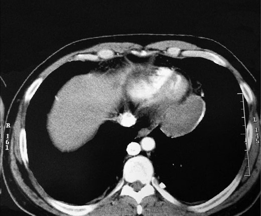 Chest CT with contrast showing mediastinal cysts.