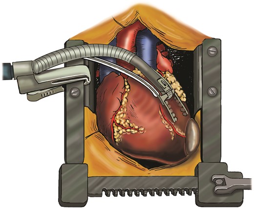 Illustration of the Octopus IV cardiac stabilizer positioning the heart, enabling the excision of the second hydatid cyst without an additional incision. The authors thank Helen Carruthers from the Department of Medical Illustrations at the University Hospital of South Manchester for the creation of this illustration.