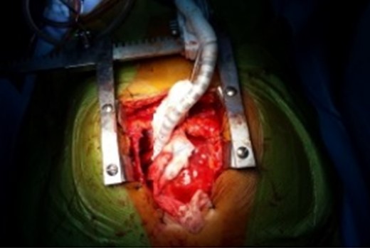 Intraoperative photograph of the Octopus IV cardiac stabilizer maintaining the position of the heart to expose the posterior hydatid cyst.