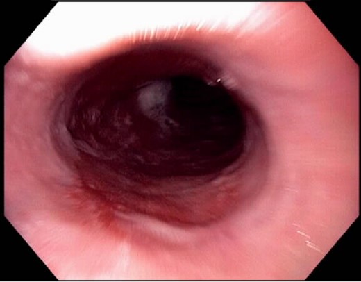 Long-segment Barrett's mucosa prior to the treatment.
