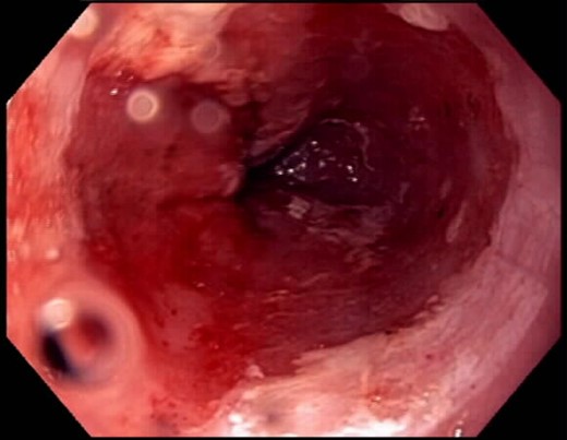 Post-procedure after second ablation.