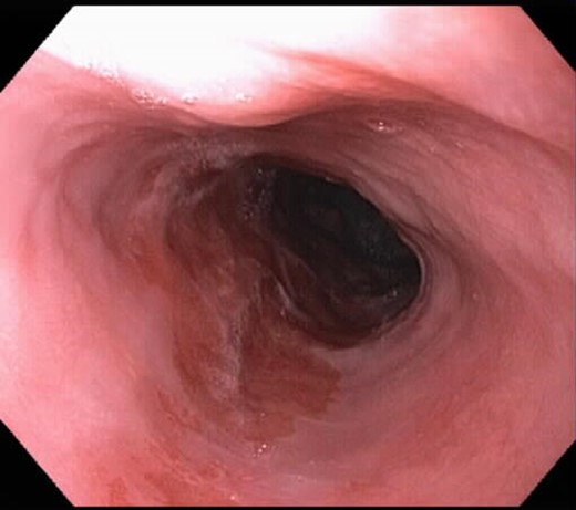 Healing segment prior to the third ablation.