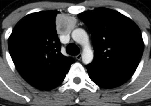 Contrast-enhanced CT showing an anterior mediastinal tumor with suspected invasion of the SVC.
