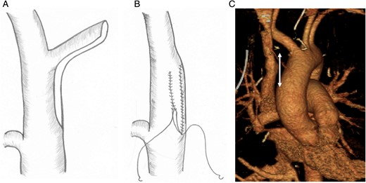 Reconstruction of the SVC with the left brachiocephalic vein. (A) After transection of the distal side of the left brachiocephalic vein with a stapler and extirpation of the tumor with partial resection of the SVC, the caudal side of the left brachiocephalic vein was divided longitudinally. (B) A pedicled flap was then made from the left brachiocephalic vein and sewn onto the SVC defect. (C) Postoperative three-dimensional CT showing patency of the reconstructed SVC. The two-directional arrow indicates the range of repair.