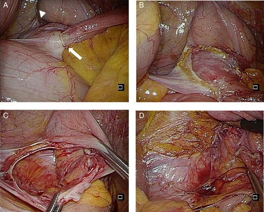 Intraoperative pictures. (A) Small bowel incarcerated in the retrocecal fossa (arrow). Cecum represented by arrow head. (B) Partially opened hernia sac. (C) Hernia sac after small bowel reduced. (D) Completely opened hernia sac.