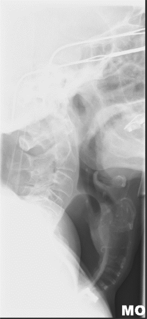 Lateral neck X-ray showing dilated oesophagus displacing trachea anteriorly.
