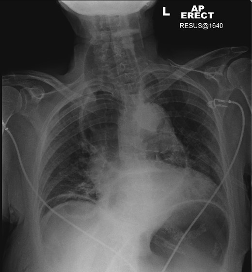 Chest X-ray: megaoesophagus behind trachea.