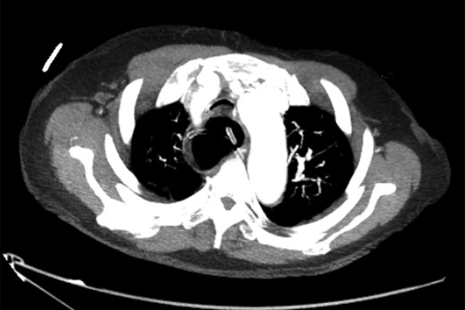 Axial slice of CT chest after nasogastric decompression showing persistent megaoesophagus and airway narrowing.