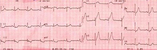 Electrocardiogram of the patient during the early time of admission showed ST elevation myocardial ischemia.