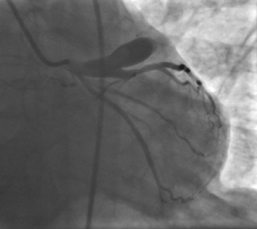 Coronary angiography showing giant coronary aneurysm originating from the proximal part of left anterior descending coronary artery.
